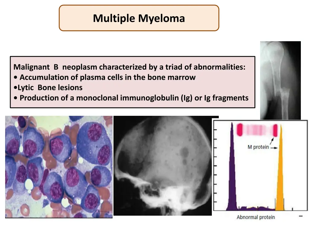 multiple myeloma