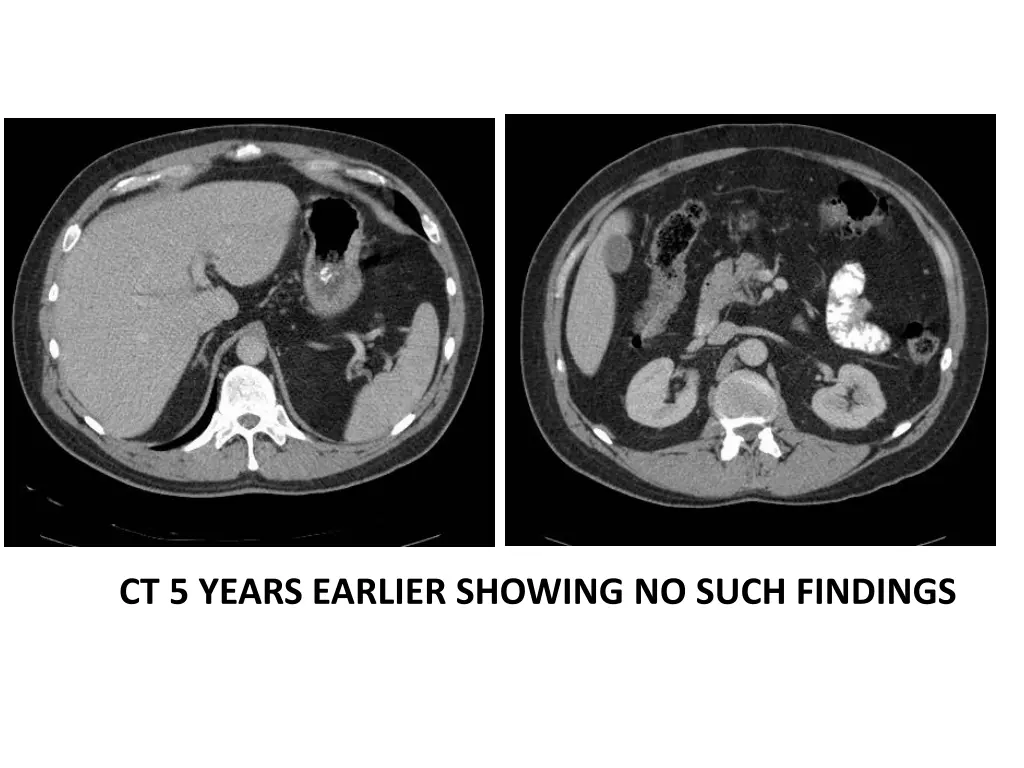 ct 5 years earlier showing no such findings