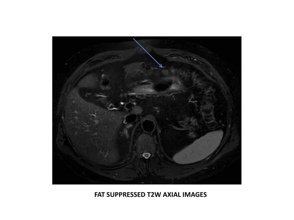 fat suppressed t2w axial images 1