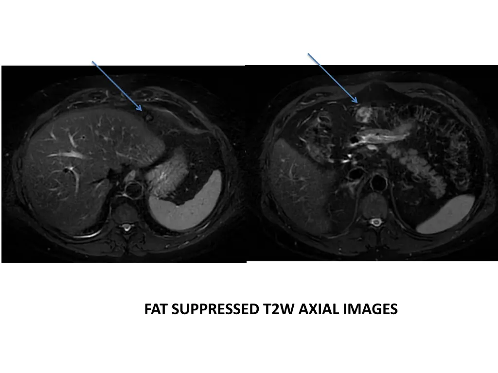 fat suppressed t2w axial images