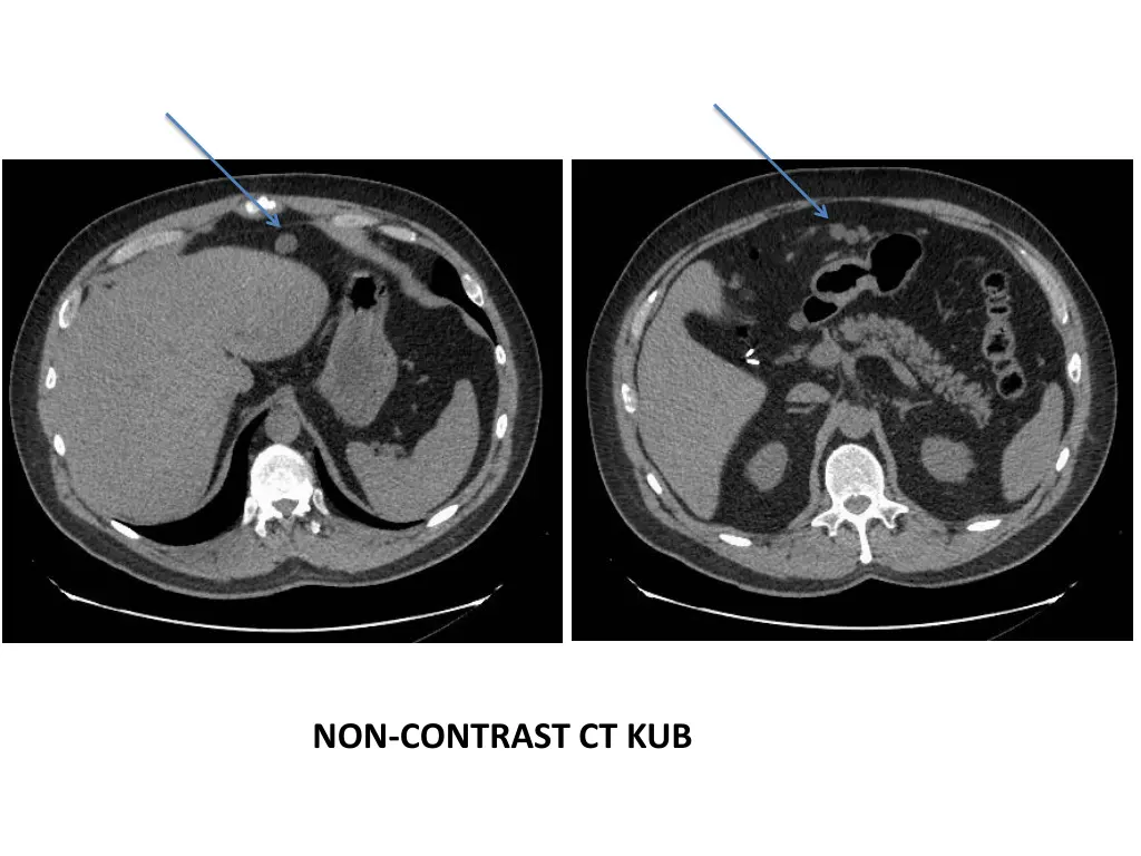 non contrast ct kub