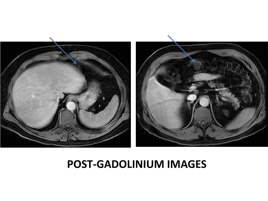 post gadolinium images