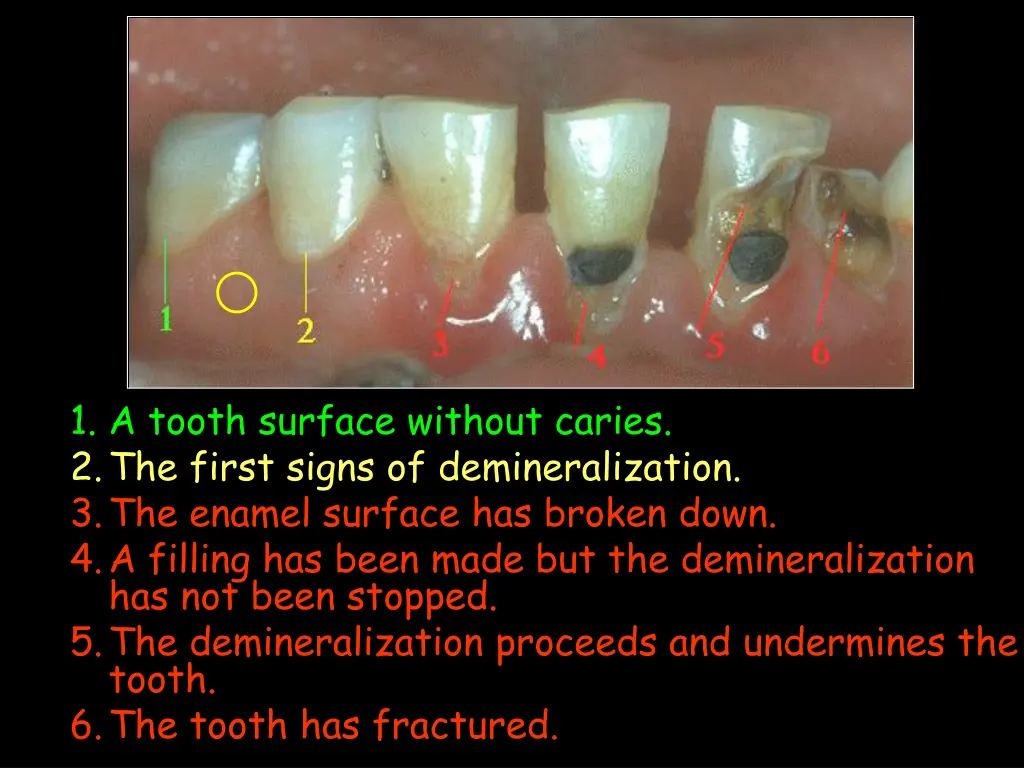 1 a tooth surface without caries 2 the first