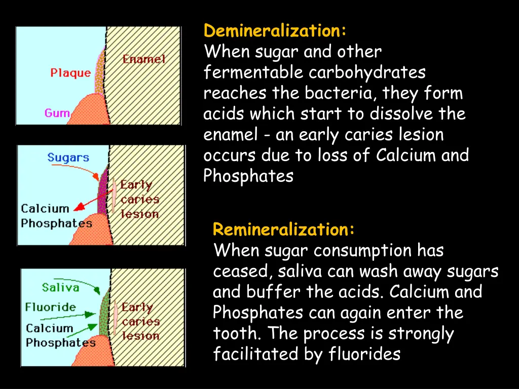 demineralization when sugar and other fermentable