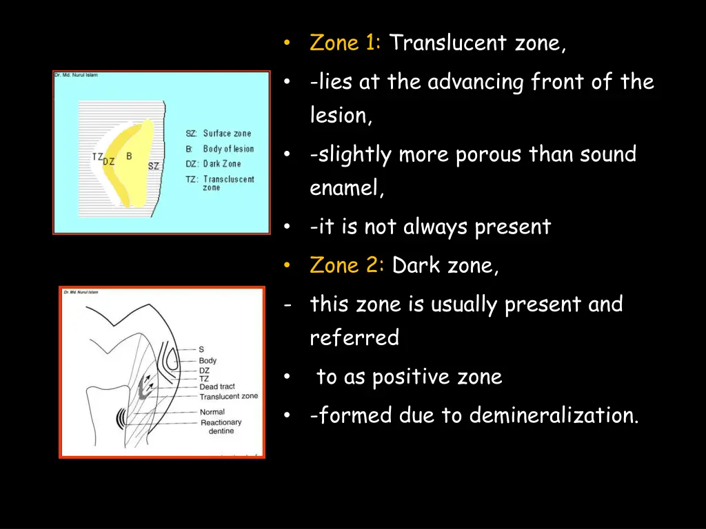 zone 1 translucent zone lies at the advancing