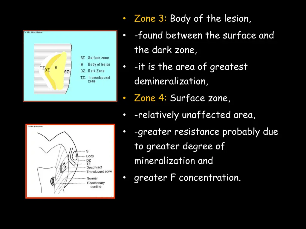 zone 3 body of the lesion found between