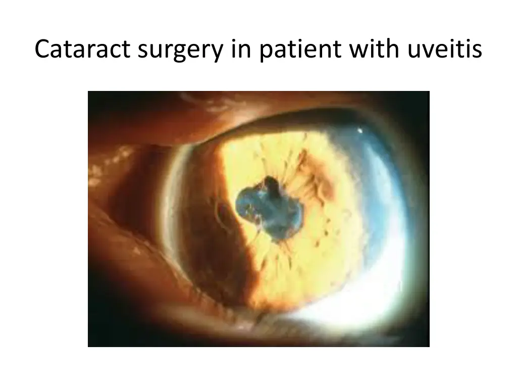 cataract surgery in patient with uveitis