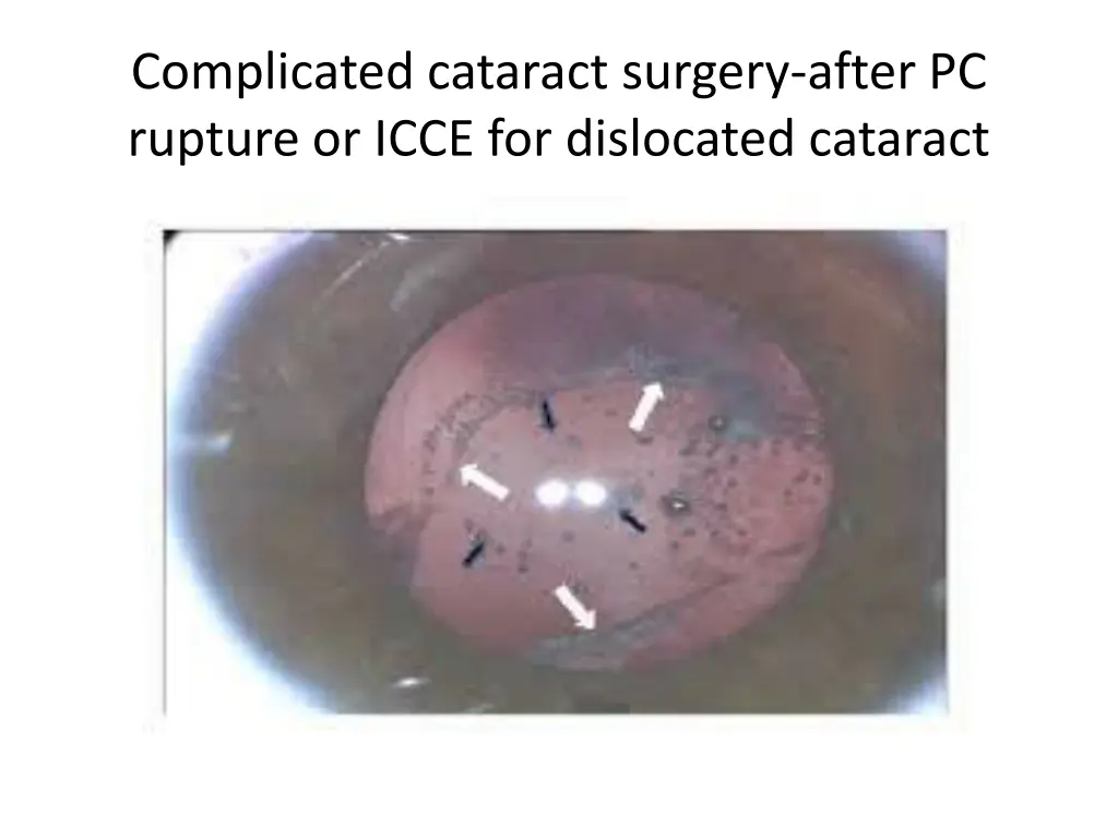 complicated cataract surgery after pc rupture