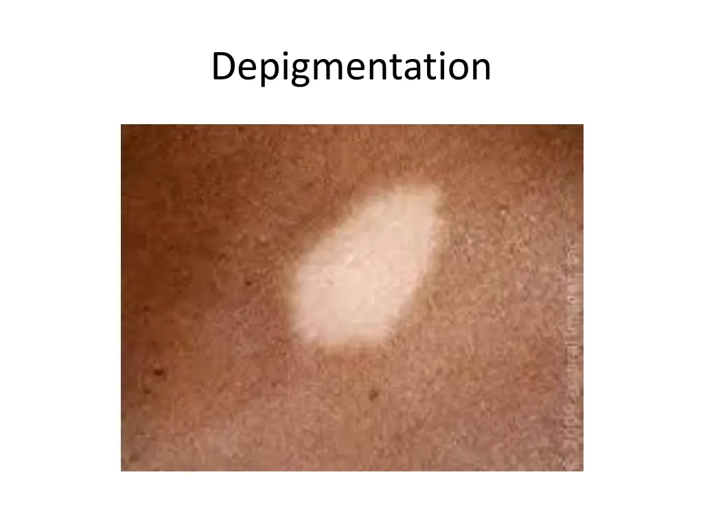 depigmentation