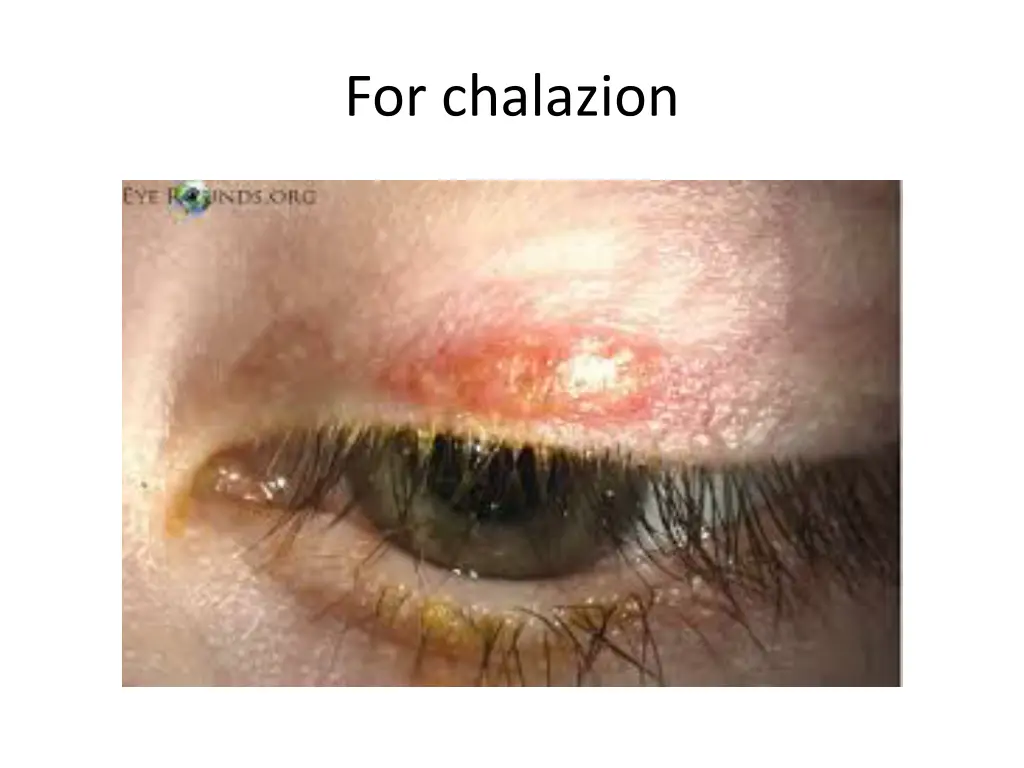 for chalazion