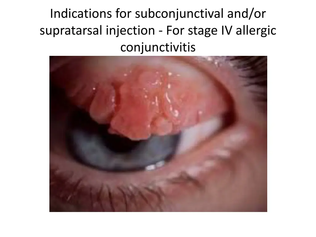 indications for subconjunctival