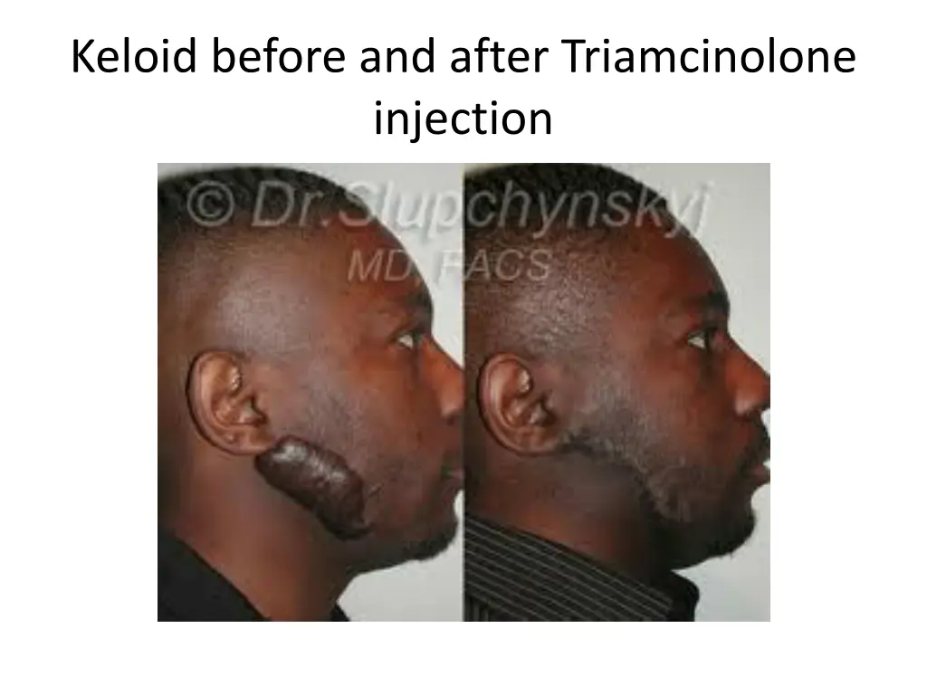 keloid before and after triamcinolone injection