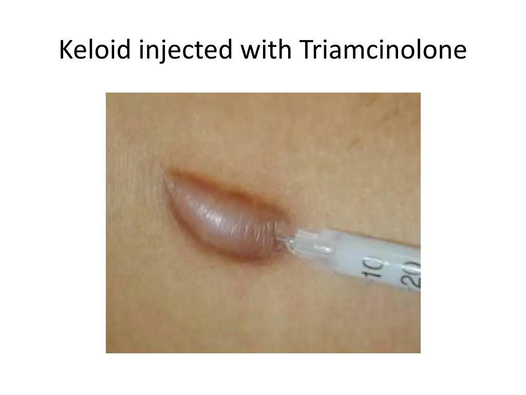 keloid injected with triamcinolone