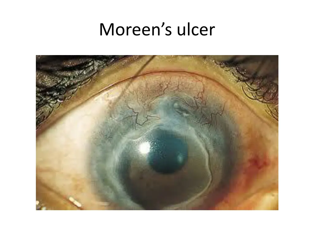 moreen s ulcer