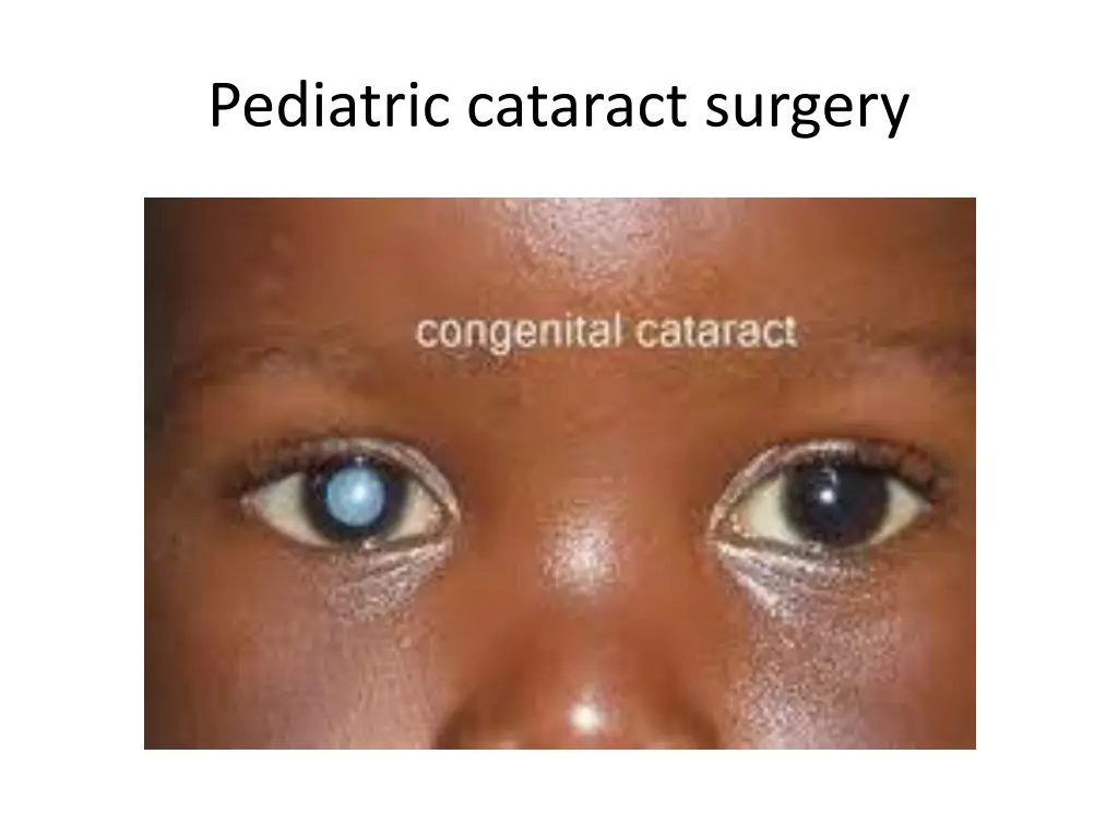 pediatric cataract surgery