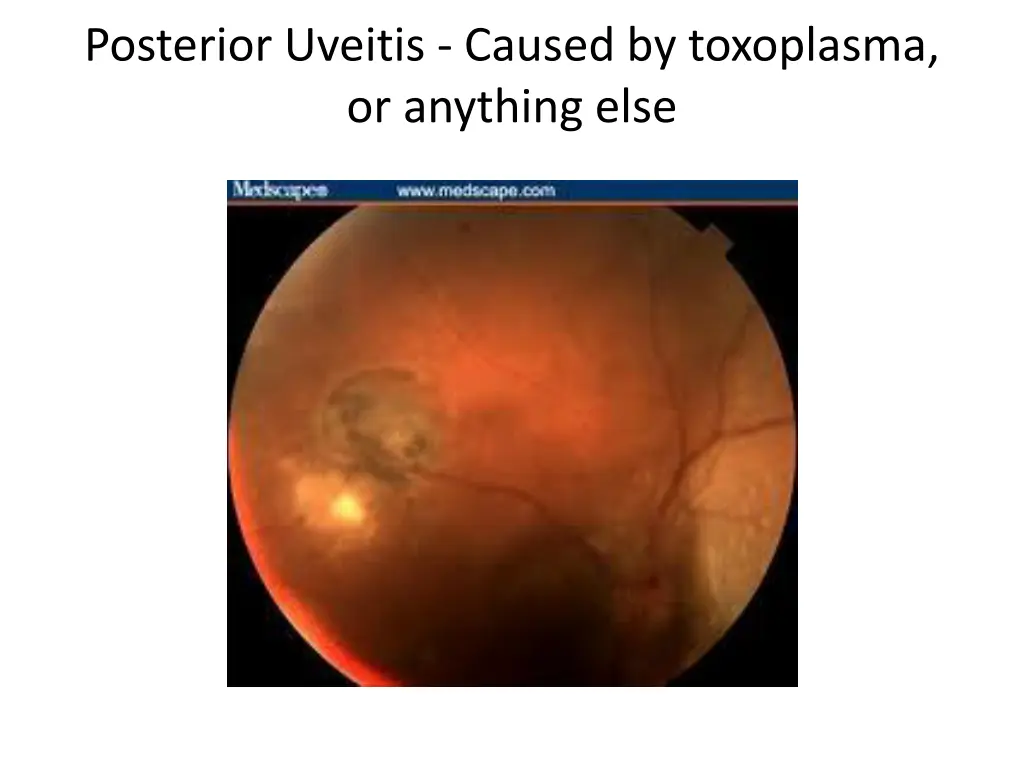 posterior uveitis caused by toxoplasma