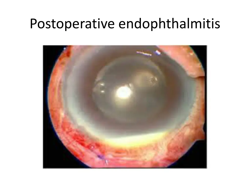 postoperative endophthalmitis