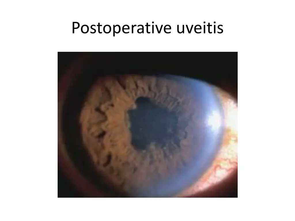 postoperative uveitis