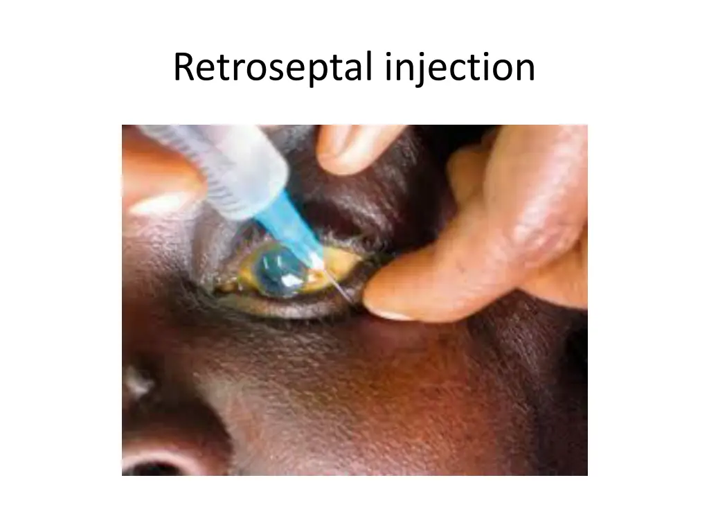 retroseptal injection 1