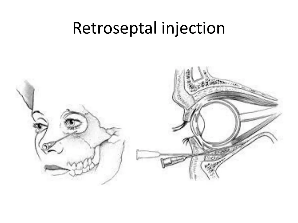 retroseptal injection