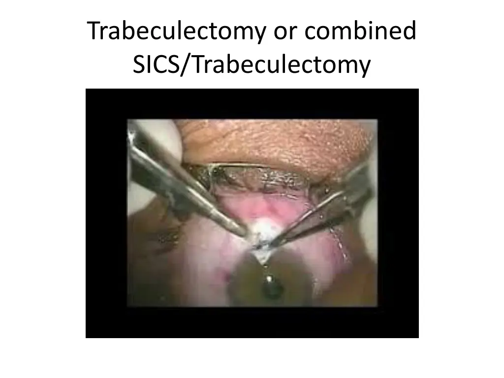 trabeculectomy or combined sics trabeculectomy