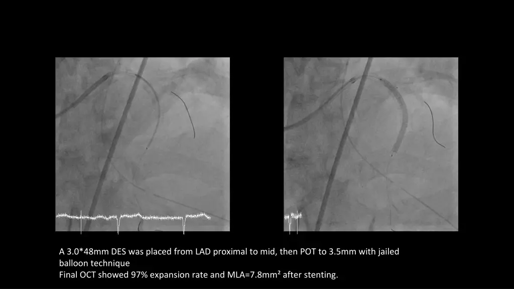 a 3 0 48mm des was placed from lad proximal