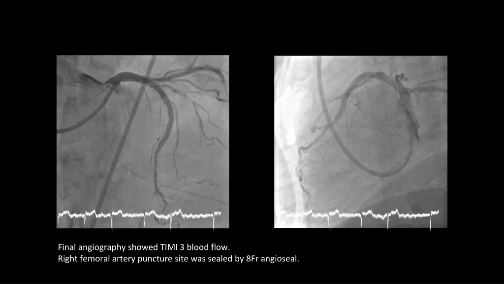 final angiography showed timi 3 blood flow right