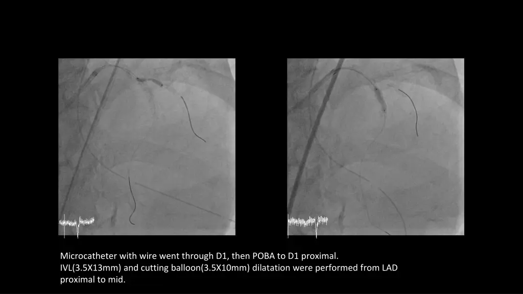 microcatheter with wire went through d1 then poba