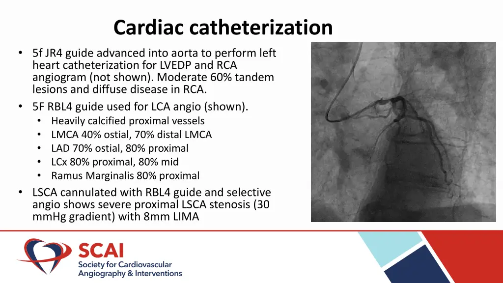 cardiac catheterization 5f jr4 guide advanced