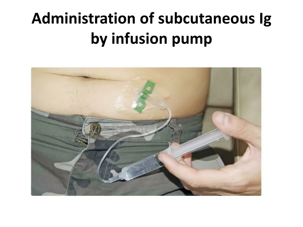 administration of subcutaneous ig by infusion pump