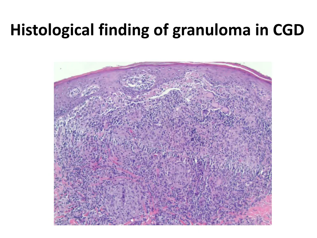 histological finding of granuloma in cgd