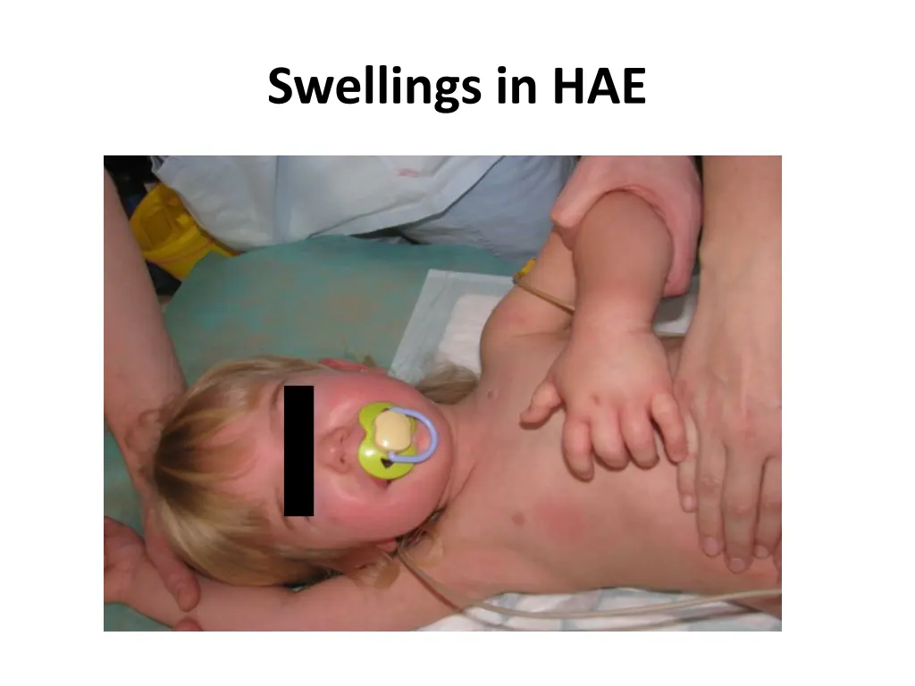 swellings in hae