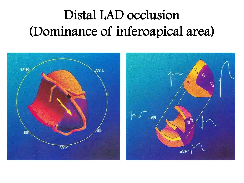 distal lad occlusion distal lad occlusion 1