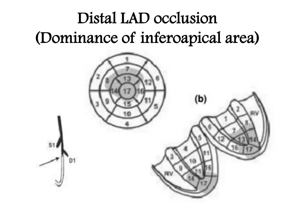 distal lad occlusion distal lad occlusion