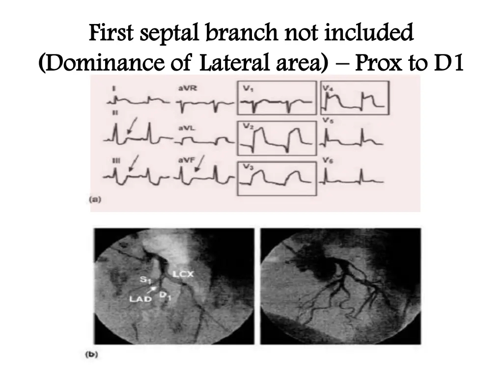 first septal branch not included first septal 3