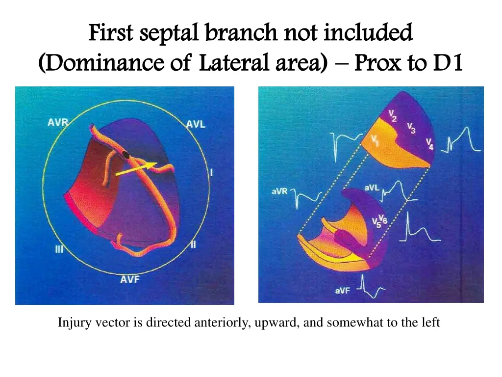 first septal branch not included first septal