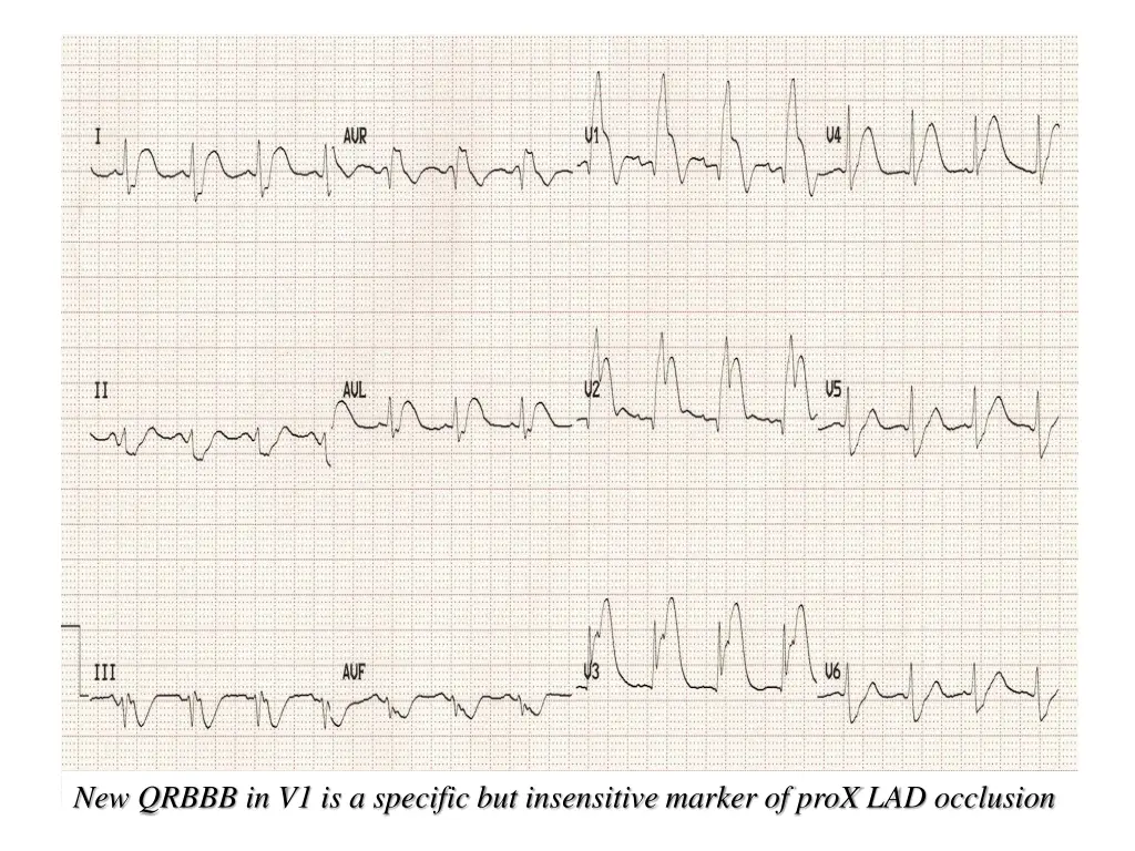 new qrbbb in v1 is a specific but insensitive