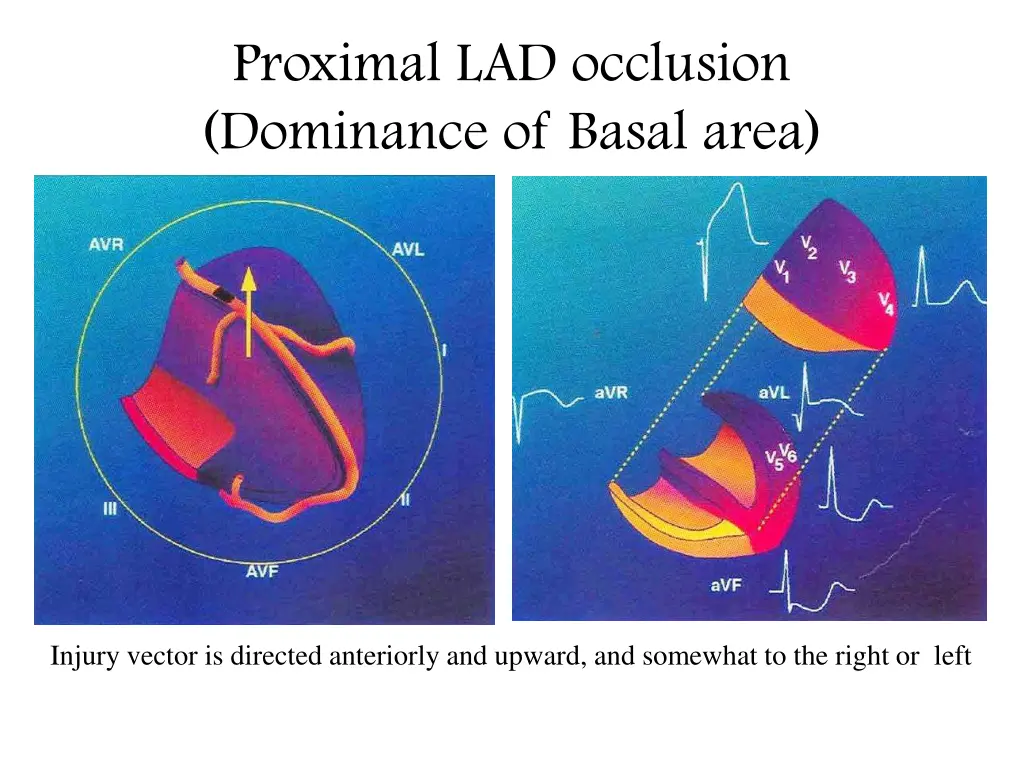 proximal lad occlusion dominance of basal area