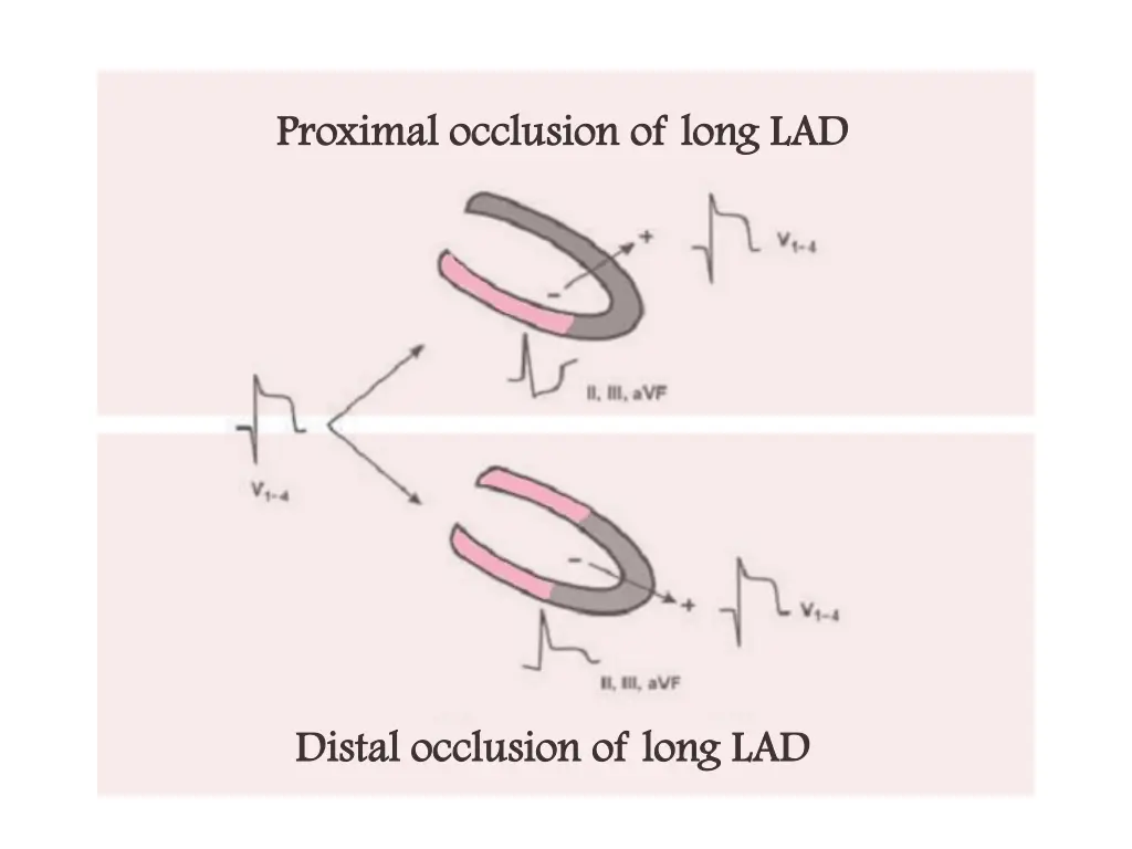 proximal occlusion of long lad proximal occlusion