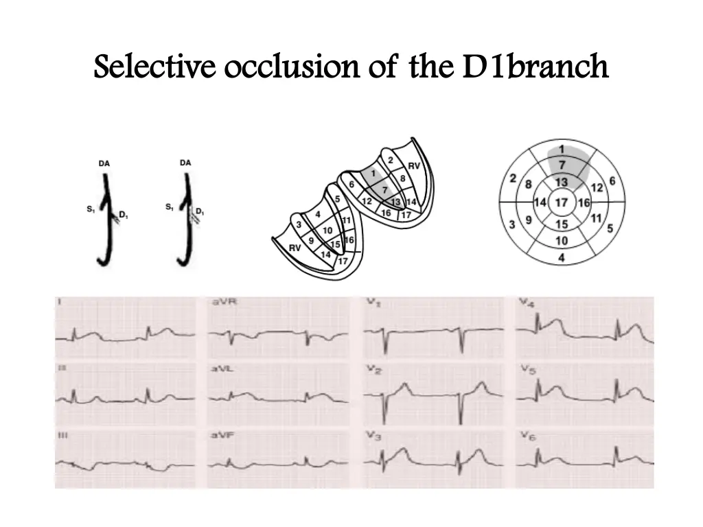 selective occlusion of the d1branch selective 1