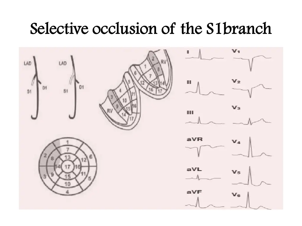 selective occlusion of the s1branch selective 1