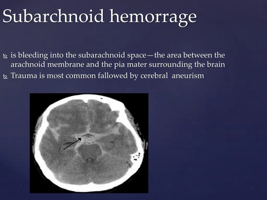 subarchnoid hemorrage