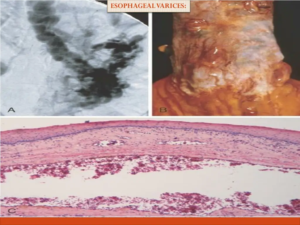 esophageal varices