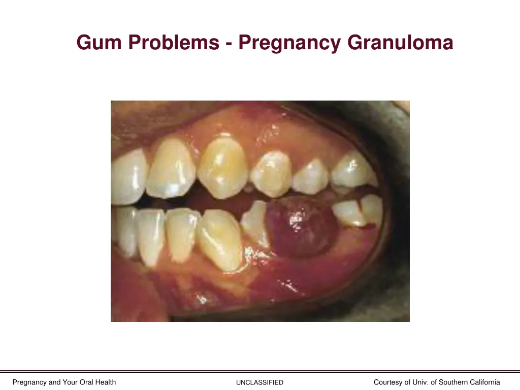 gum problems pregnancy granuloma 1