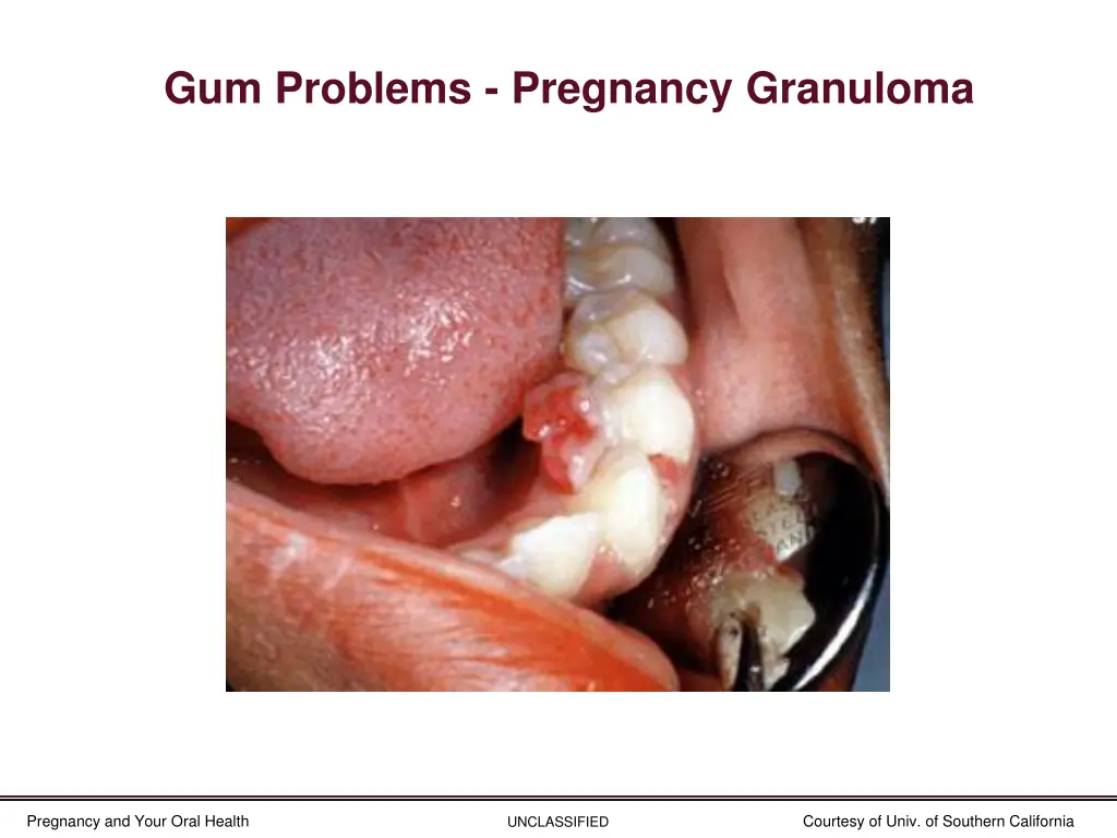 gum problems pregnancy granuloma