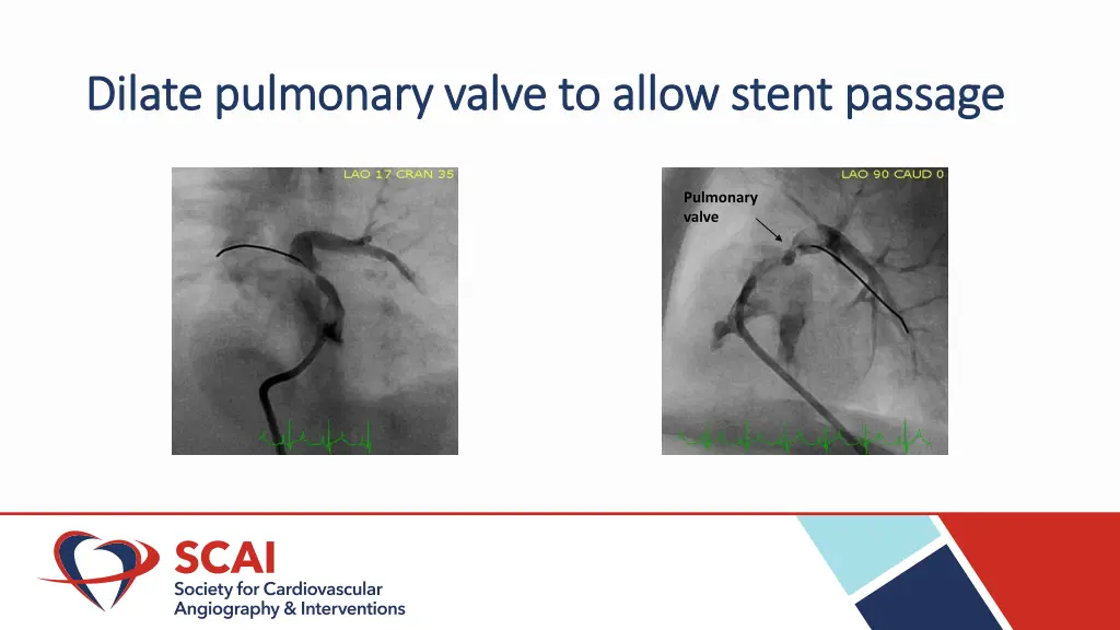 dilate pulmonary valve to allow stent passage