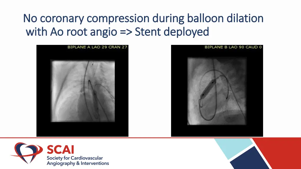 no coronary compression during balloon dilation