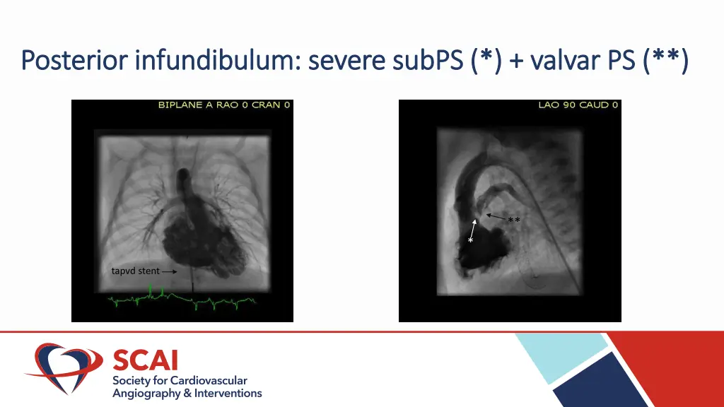 posterior infundibulum severe posterior