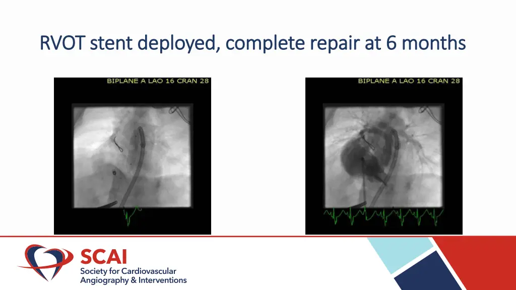 rvot stent deployed complete repair at 6 months