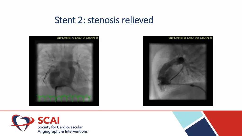 stent 2 stenosis relieved stent 2 stenosis